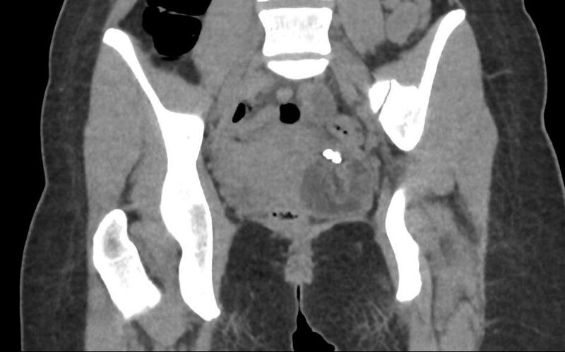 File:Bilateral mature cystic ovarian teratoma (Radiopaedia 88821-105592 Coronal non-contrast 19).jpg