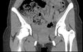 Bilateral mature cystic ovarian teratoma (Radiopaedia 88821-105592 Coronal non-contrast 2).jpg
