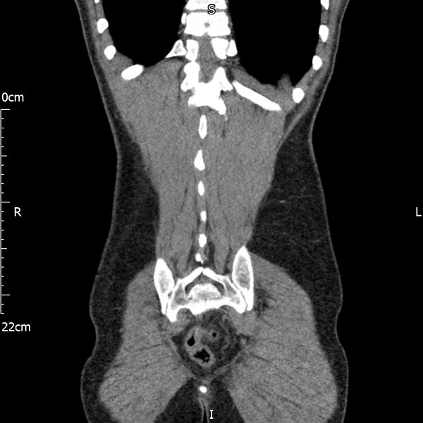 File:Bilateral medullary nephrocalcinosis with ureteric calculi (Radiopaedia 71269-81569 Coronal non-contrast 64).jpg