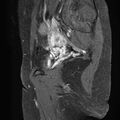 Bilateral ovarian endometriomas (Radiopaedia 87085-103347 F 19).jpg