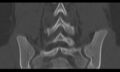 Bilateral pars defect (Radiopaedia 26691-26846 Coronal bone window 34).jpg