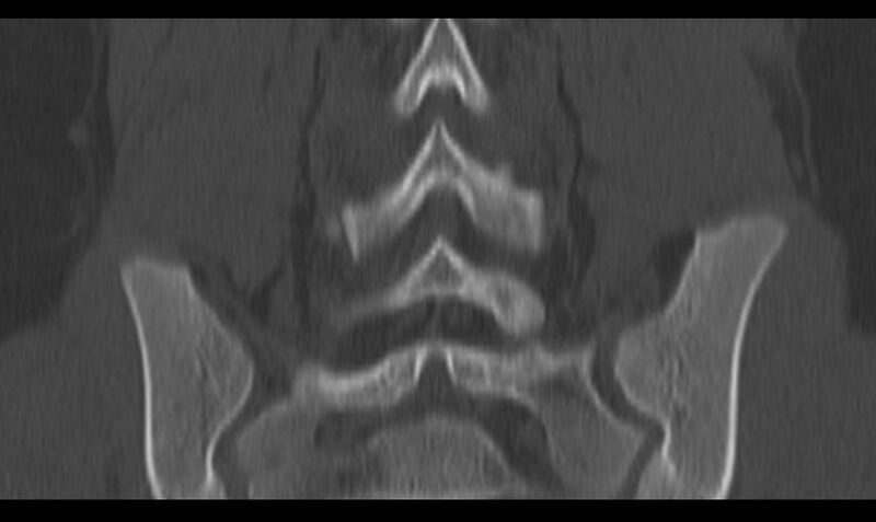 File:Bilateral pars defect (Radiopaedia 26691-26846 Coronal bone window 34).jpg