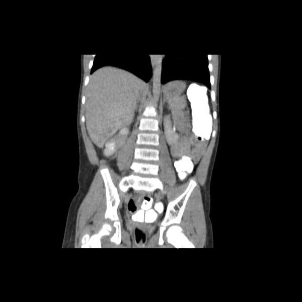 File:Bilateral renal malrotation (Radiopaedia 30901-31606 Coronal C+ delayed 2).jpg