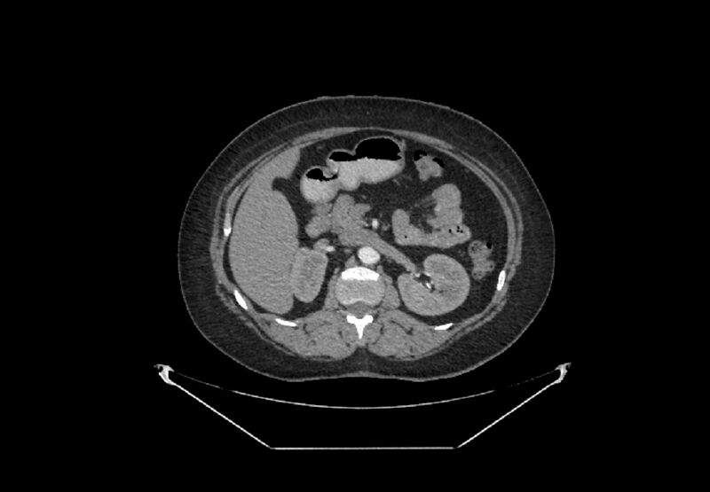 File:Bilateral urolithiasis with incidentally detected splenic artery aneurysm and left inferior vena cava (Radiopaedia 44467-48127 A 33).jpg