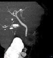 Bile leak from accessory duct(s) of Luschka post cholecystectomy (Radiopaedia 40736-43389 D 4).jpg
