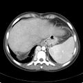 Biliary necrosis - liver transplant (Radiopaedia 21876-21846 B 10).jpg