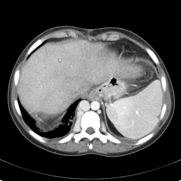 File:Biliary necrosis - liver transplant (Radiopaedia 21876-21846 B 10).jpg