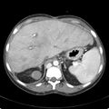 Biliary necrosis - liver transplant (Radiopaedia 21876-21846 B 17).jpg