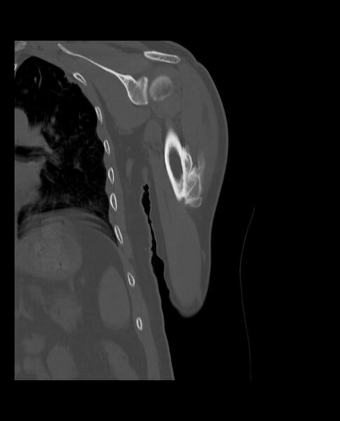 File:Bizarre parosteal osteochondromatous proliferation (Radiopaedia 84221-99501 Coronal bone window 14).jpg