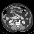 Bladder papillary urothelial carcinoma (Radiopaedia 48119-52951 A 20).png