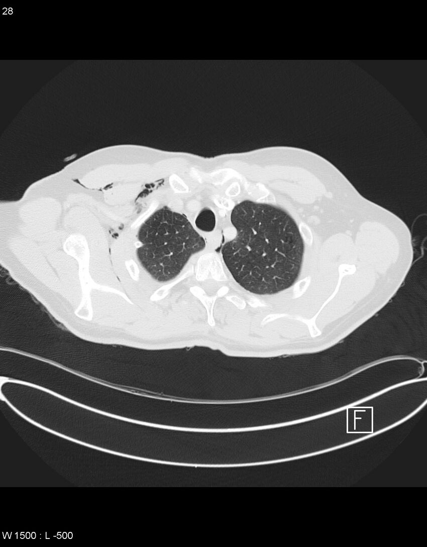 Boerhaave syndrome with tension pneumothorax (Radiopaedia 56794-63605 Axial lung window 13).jpg