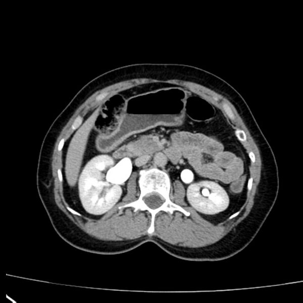 File:Bosniak renal cyst - type I (Radiopaedia 27479-27675 D 18).jpg