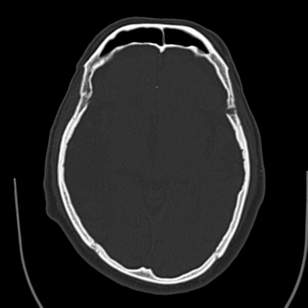 File:Brain Pantopaque remnants (Radiopaedia 78403-91048 Axial bone window 35).jpg