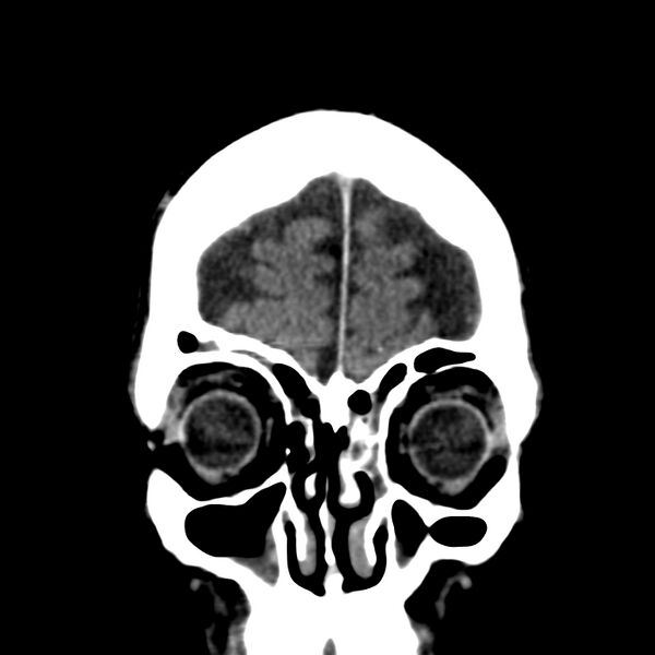File:Brain Pantopaque remnants (Radiopaedia 78403-91048 Coronal non-contrast 11).jpg