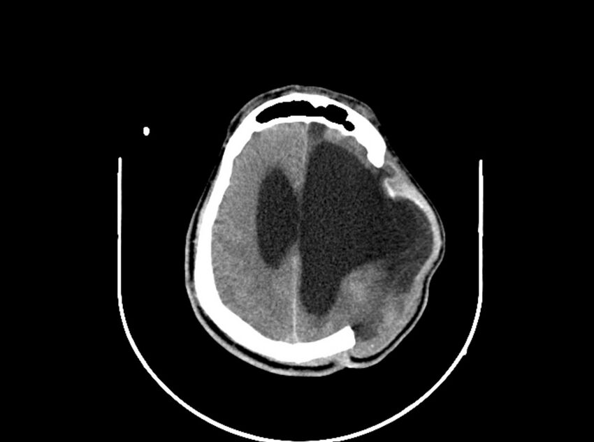 Brain injury by firearm projectile (Radiopaedia 82068-96088 A 154).jpg