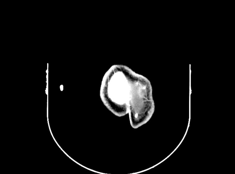 File:Brain injury by firearm projectile (Radiopaedia 82068-96088 B 204).jpg