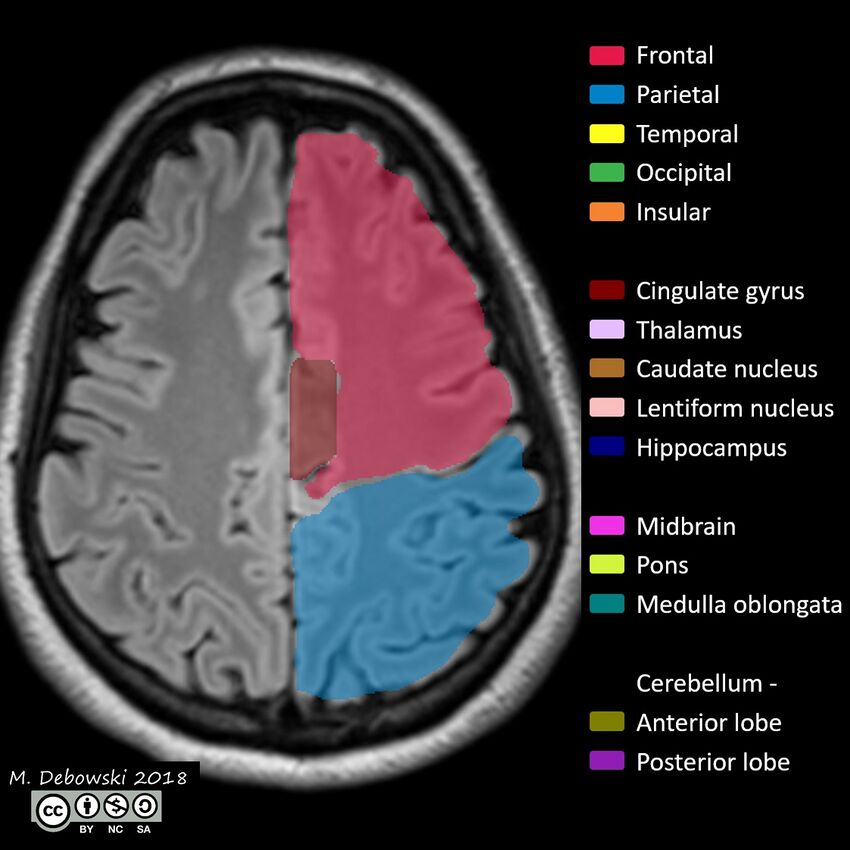 Brain lobes - annotated MRI (Radiopaedia 61691-69700 Axial 20).JPG