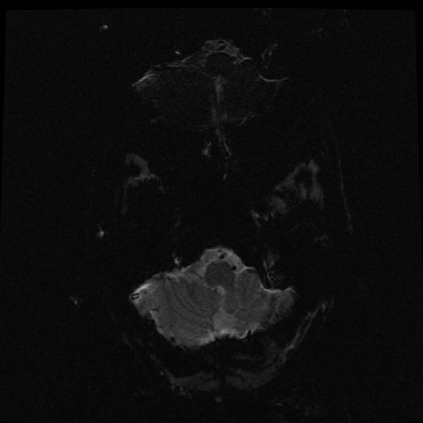 Brain metastases (renal cell carcinoma) (Radiopaedia 42571-45704 Axial SWI 56).jpg
