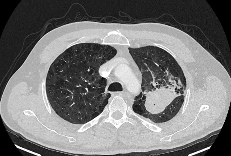 File:Brain metastases - lung cancer primary (Radiopaedia 75060-86116 Axial lung window 13).jpg