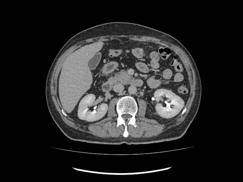 File:Brain metastases from renal cell carcinoma (Radiopaedia 42222-45328 Axial C+ delayed 92).jpg