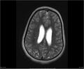 Brainstem glioma (Radiopaedia 21819-21775 Axial T2 27).jpg