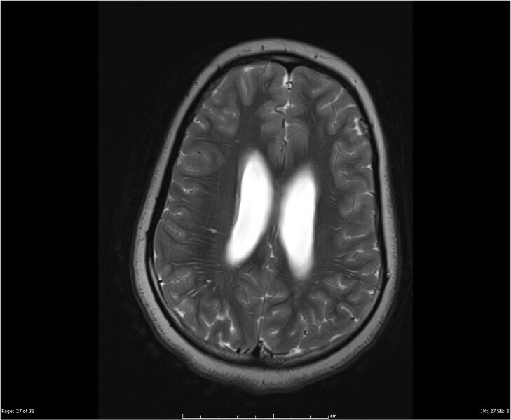 File:Brainstem glioma (Radiopaedia 21819-21775 Axial T2 27).jpg
