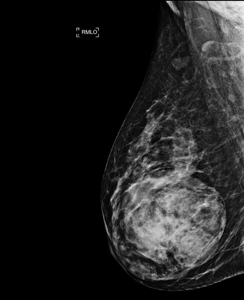 File:Breast hamartoma (Radiopaedia 63719-72417 MLO 1).jpg