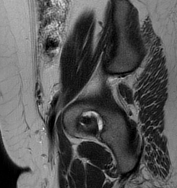 File:Broad ligament leiomyoma (Radiopaedia 81634-95516 Sagittal T2 4).jpg