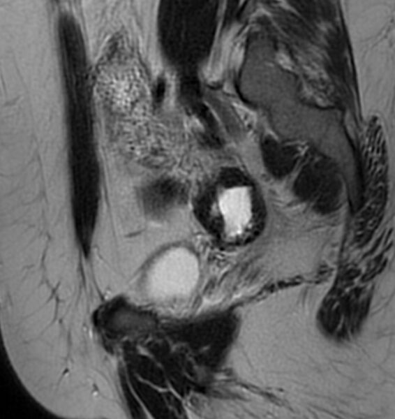 File:Broad ligament leiomyoma (Radiopaedia 81634-95516 Sagittal T2 9).jpg