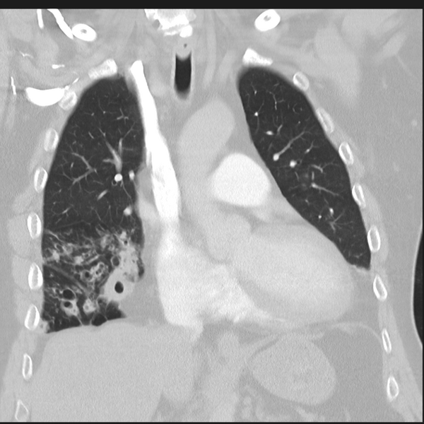 File:Bronchiectasis (Radiopaedia 39385-41666 Coronal lung window 12).png