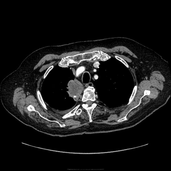 File:Bronchogenic adenocarcinoma and pulmonary embolism (Radiopaedia 9097-9806 D 16).jpg