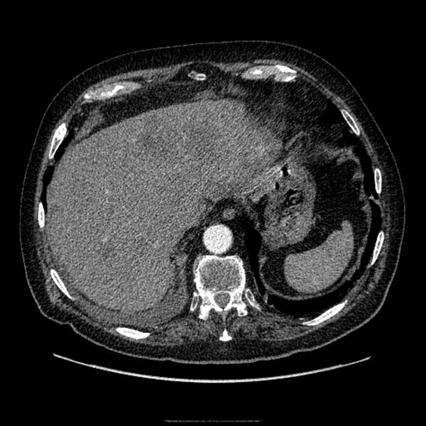 File:Bronchogenic adenocarcinoma and pulmonary embolism (Radiopaedia 9097-9806 D 51).jpg