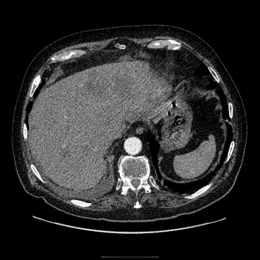 Bronchogenic adenocarcinoma and pulmonary embolism (Radiopaedia 9097-9806 D 51).jpg