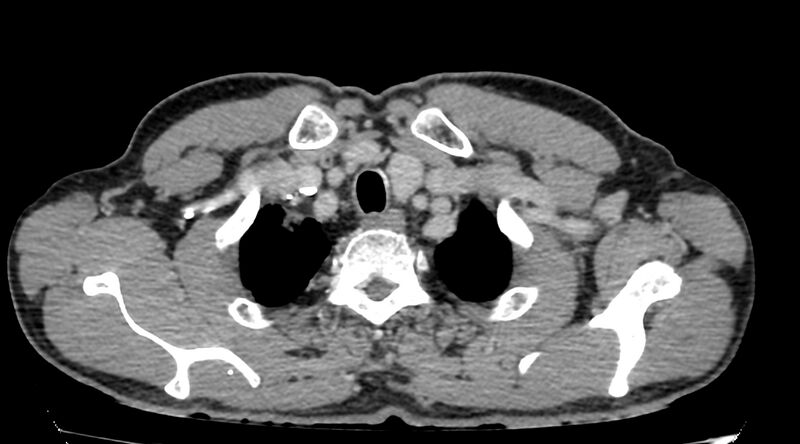 File:Bronchogenic carcinoma with superior vena cava syndrome (Radiopaedia 36497-38054 Axial C+ delayed 1).jpg