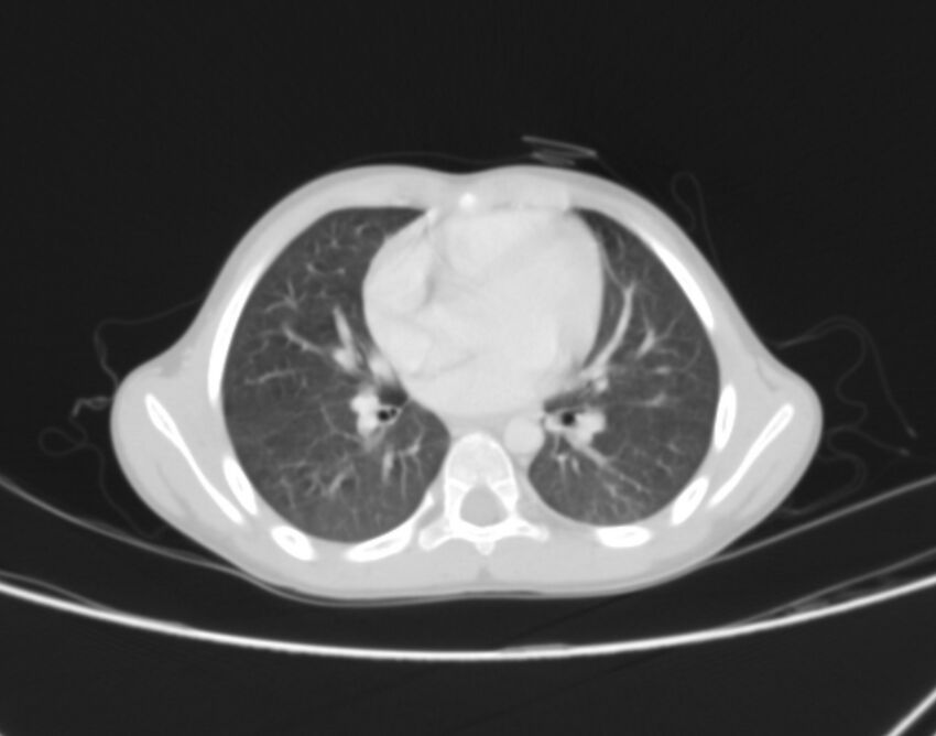 Bronchus suis (Radiopaedia 68131-77620 Axial lung window 50).jpg