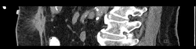 File:Buried bumper syndrome - gastrostomy tube (Radiopaedia 63843-72575 Sagittal Inject 57).jpg