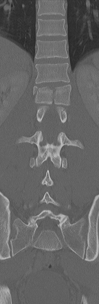 File:Burst fracture - T12 with conus compression (Radiopaedia 56825-63647 Coronal bone window 24).png