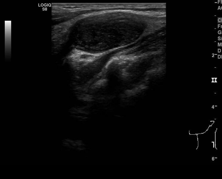 File:C5 nerve sheath tumor (Radiopaedia 85777-101616 Longitudinal 1).jpg