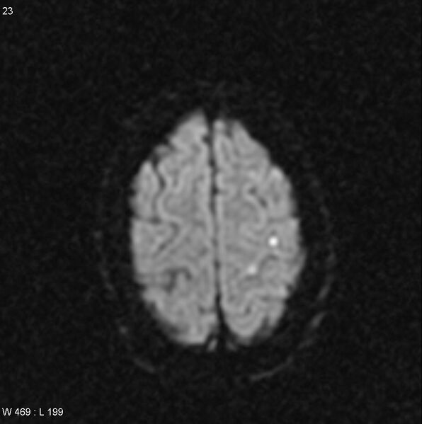File:CMV ventriculitis and encephalitis (Radiopaedia 5416-7166 Axial DWI 9).jpg
