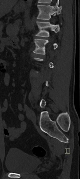 File:Calcaneal fractures with associated L2 burst fracture (Radiopaedia 71671-82493 Sagittal bone window 18).jpg