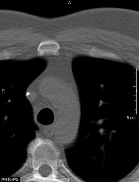 File:Calcified cardiac fibroma (Radiopaedia 39267-41519 Axial bone window 3).jpg