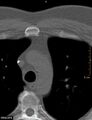 Calcified cardiac fibroma (Radiopaedia 39267-41519 Axial bone window 3).jpg