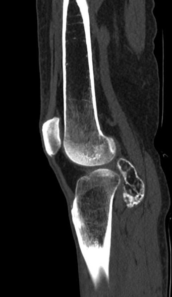 File:Calcified hematoma - popliteal fossa (Radiopaedia 63938-72763 Sagittal bone window 76).jpg