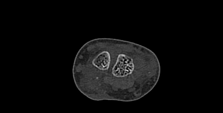 Calcifying aponeurotic fibroma (Radiopaedia 88423-105064 Axial bone window 52).jpg