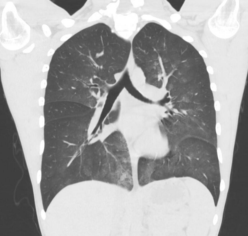 Cannabis-induced diffuse alveolar hemorrhage (Radiopaedia 89834-106946 Coronal lung window 42).jpg