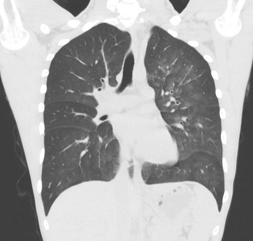 Cannabis-induced diffuse alveolar hemorrhage (Radiopaedia 89834-106946 Coronal lung window 47).jpg