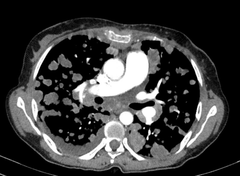 File:Cannonball metastases from breast cancer (Radiopaedia 91024-108569 A 57).jpg