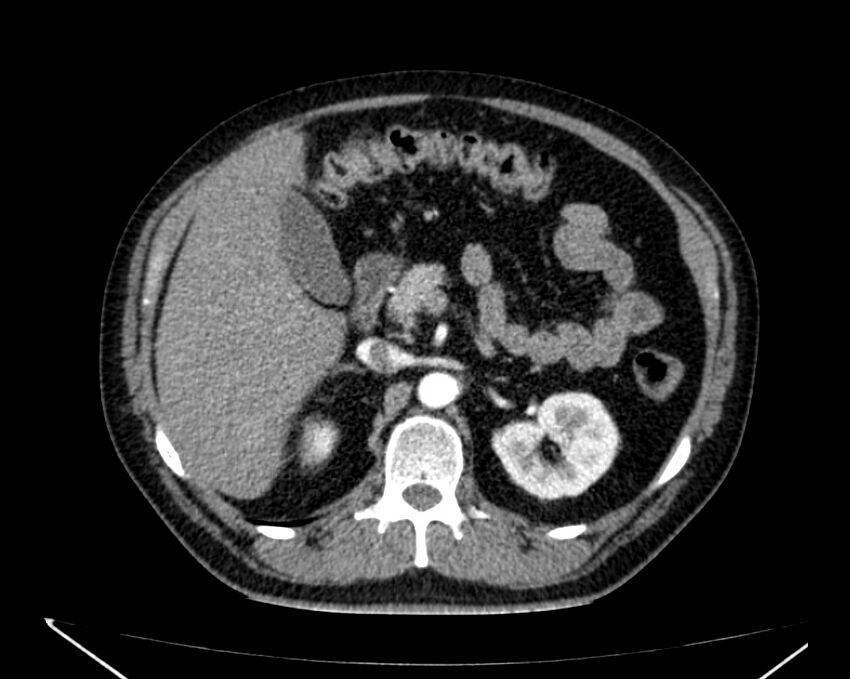 Carcinoid tumor with hepatic metastases (Radiopaedia 22651-22670 B 30).jpg