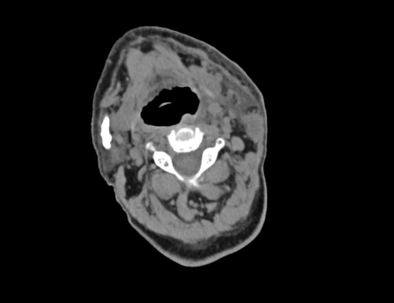 File:Carotid artery pseudoaneurysm (Radiopaedia 84030-99259 Axial non-contrast 13).jpg