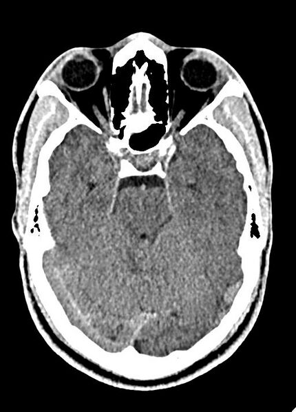 File:Cavum septum pellucidum and cavum vergae (Radiopaedia 77797-90060 Axial Brain Window 36).jpg